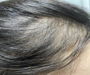 Rụng tóc do Telogen Effluvium thường xuất hiện trên toàn bộ da đầu, chứ không tập trung ở một vùng cụ thể