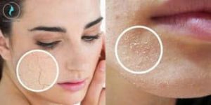 Một số cách giúp bạn khắc phục tình trạng da bong tróc khi dùng Retinol